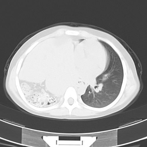 File:Bochdalek diaphragmatic hernia (Radiopaedia 38866-41059 Axial lung window 14).jpg