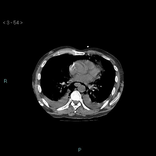 Boerhaave syndrome (Radiopaedia 27683-27897 Axial non-contrast 54).jpg
