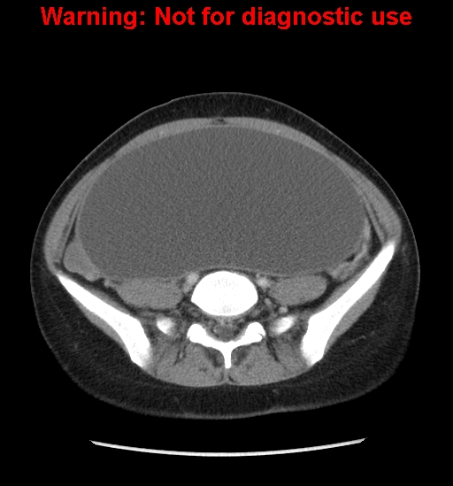 Borderline mucinous cystadenoma of ovary (Radiopaedia 25586-25767 A 63).jpg