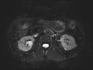 File:Bouveret syndrome (Radiopaedia 61017-68856 Axial MRCP 36).jpg