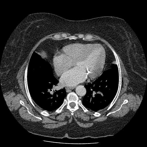 Bovine aortic arch - right internal mammary vein drains into the superior vena cava (Radiopaedia 63296-71875 A 97).jpg