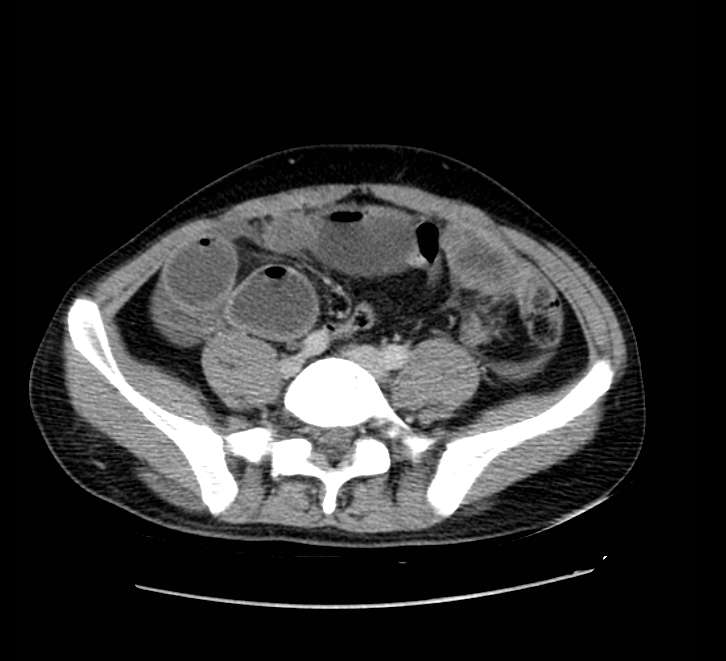Bowel obstruction from colon carcinoma (Radiopaedia 22995-23028 A 59).jpg