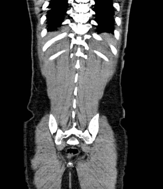 Bowel obstruction from colon carcinoma (Radiopaedia 22995-23028 C 66).jpg