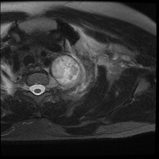File:Brachial plexus neurofibroma (Radiopaedia 28030-28291 Axial T2 fat sat 6).png