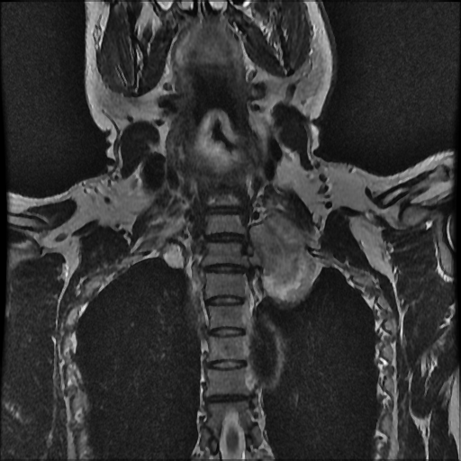File:Brachial plexus neurofibroma (Radiopaedia 28030-28291 Coronal T2 5).png