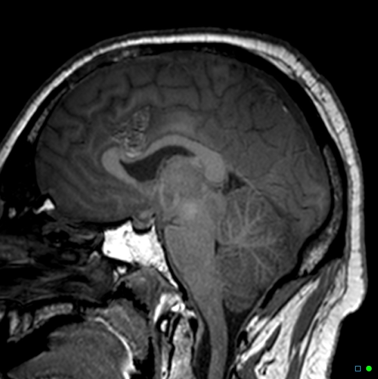 Brain death on MRI and CT angiography (Radiopaedia 42560-45689 Sagittal T1 23).jpg