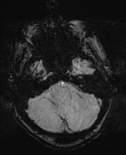 Brain metastases - lung cancer primary (Radiopaedia 75060-86115 Axial SWI 14).jpg