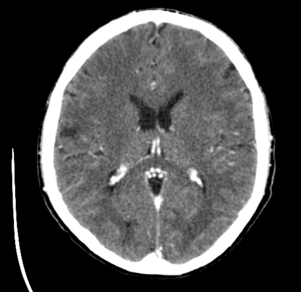 File:Brain metastases from lung cancer (Radiopaedia 24480-24781 Axial C+ delayed 34).jpg
