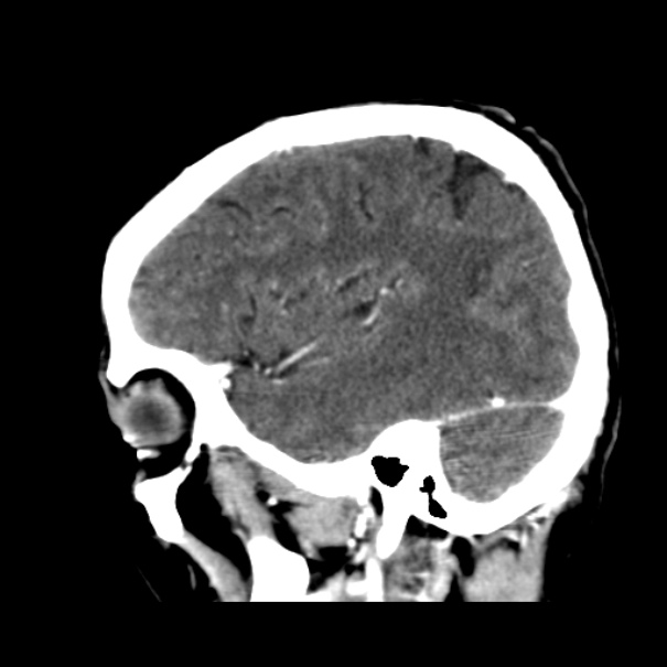 Brain metastases from lung cancer (Radiopaedia 24480-24781 C+ delayed 15).jpg
