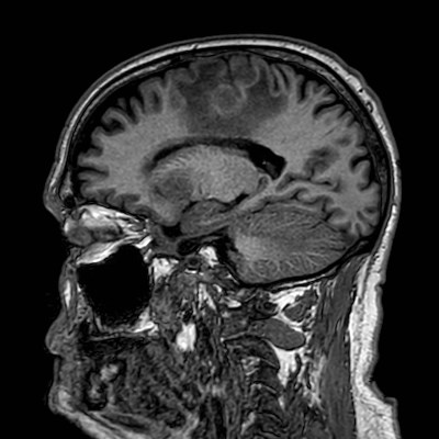 Brain metastases from lung cancer (Radiopaedia 83839-99028 Sagittal T1 82).jpg