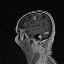 Brain metastasis (Radiopaedia 42617-45761 Sagittal T1 C+ 18).jpg