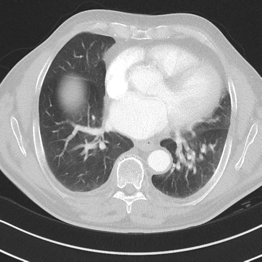File:Brain metastasis (large cystic mass) (Radiopaedia 47497-52104 Axial lung window 28).png