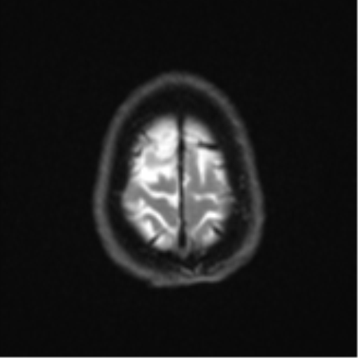 Brain metastasis (large cystic mass) (Radiopaedia 47497-52107 Axial DWI 25).png