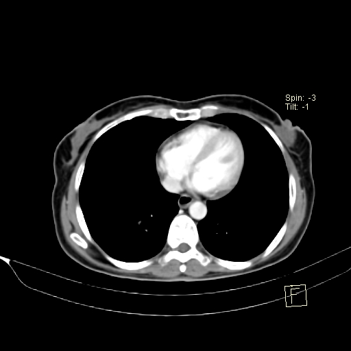 Brain metastasis as initial presentation of non-small cell lung cancer (Radiopaedia 65122-74127 A 32).jpg
