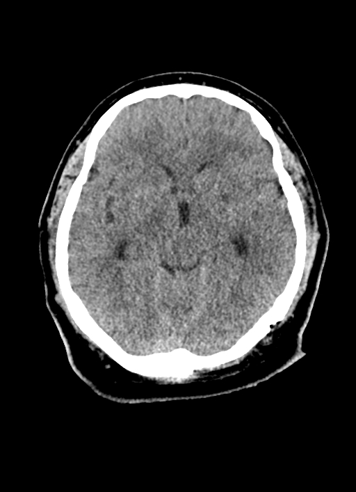 Brainstem hemorrhage (Radiopaedia 81294-94976 Axial non-contrast 36).jpg