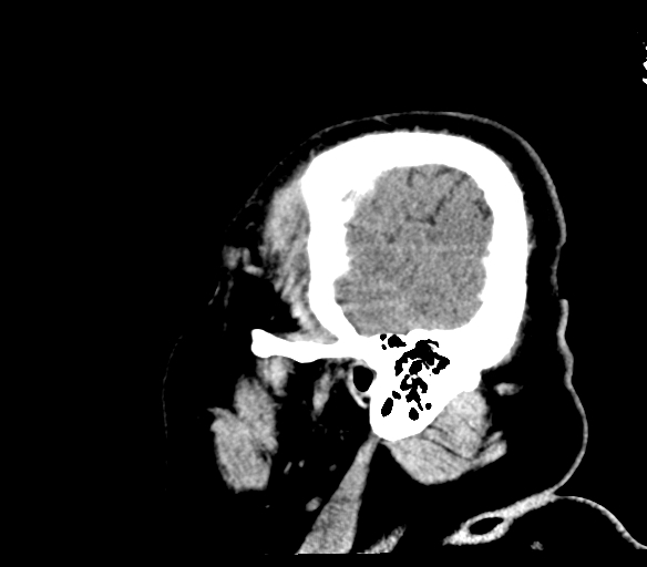 Brainstem hemorrhage (Radiopaedia 81294-94976 C 54).jpg
