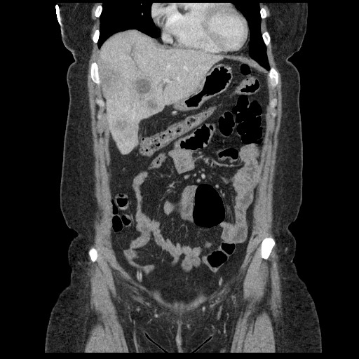 File:Breast cancer pseudocirrhosis after chemotherapy (Radiopaedia 65407-74456 Coronal 33).jpg