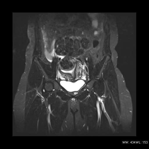 File:Broad ligament fibroid (Radiopaedia 49135-54241 Coronal STIR 10).jpg