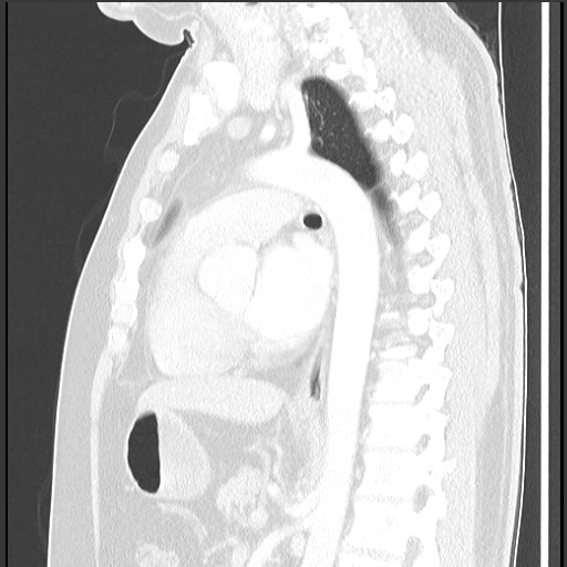 Bronchial carcinoid tumor (Radiopaedia 67377-76764 Sagittal lung window 39).jpg