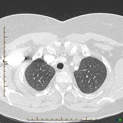 Bronchial diverticula (Radiopaedia 79512-92676 Axial lung window 19).jpg