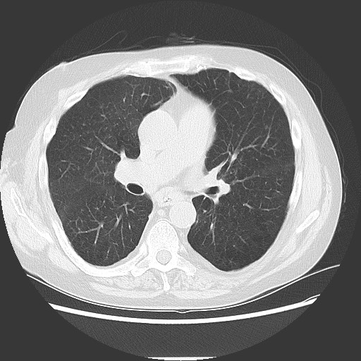 Bronchial stenosis - lung transplant (Radiopaedia 73133-83848 Axial lung window 31).jpg