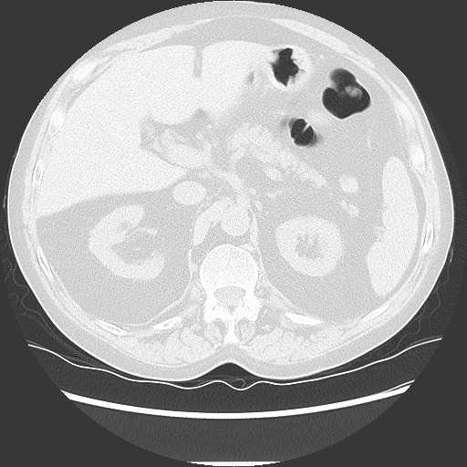 File:Bronchial stenosis - lung transplant (Radiopaedia 73133-83848 Axial lung window 63).jpg