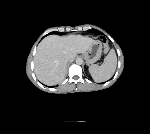 File:Bronchiectasis in Crohn disease (Radiopaedia 60311-67977 B 28).jpg