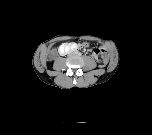 Bronchiectasis in Crohn disease (Radiopaedia 60311-67977 B 99).jpg