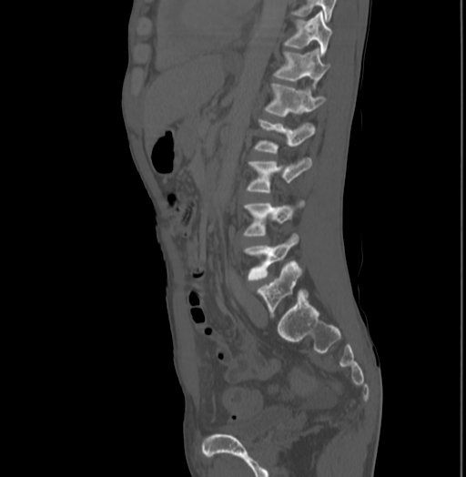 Bronchiectasis in Crohn disease (Radiopaedia 60311-67977 Sagittal bone window 149).jpg