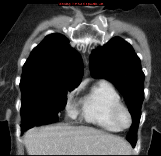 File:Bronchoalveolar carcinoma (BAC) (Radiopaedia 13436-13392 E 13).jpg