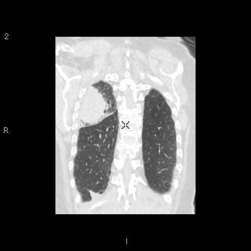 File:Bronchogenic carcinoma as an incidental finding (Radiopaedia 16453-16130 Coronal lung window 40).jpg