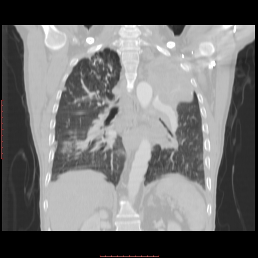 File:Bronchogenic carcinoma with left atrial large deposit - T4N3M1a (Radiopaedia 42316-45428 Coronal lung window 11).jpg