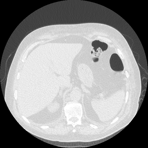Bronchogenic carcinoma with metastatic lymphadenopathy (Radiopaedia 37671-39569 Axial lung window 52).jpg
