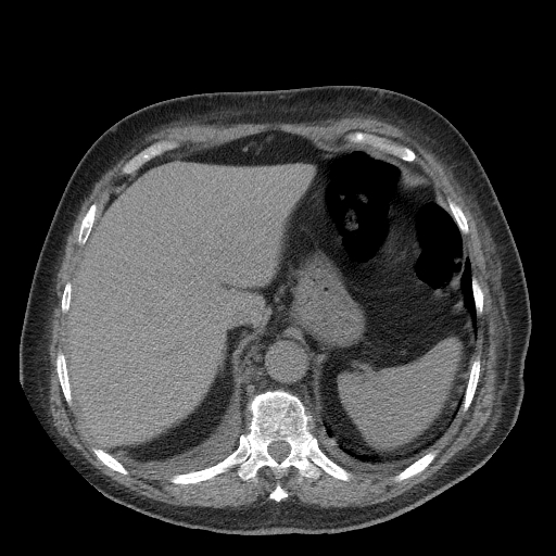 Bronchogenic carcinoma with metastatic lymphadenopathy (Radiopaedia 37671-39569 Axial non-contrast 50).jpg