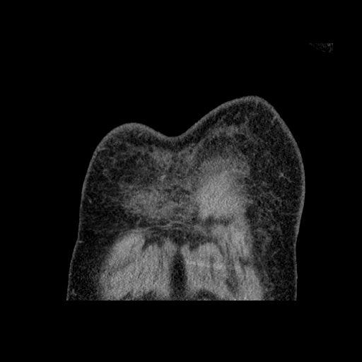 File:Bronchogenic carcinoma with metastatic lymphadenopathy (Radiopaedia 37671-39569 Coronal non-contrast 2).jpg