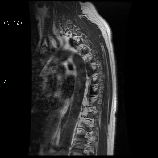 File:Bronchogenic cyst - posterior mediastinal (Radiopaedia 43885-47365 Sagittal T1 12).jpg