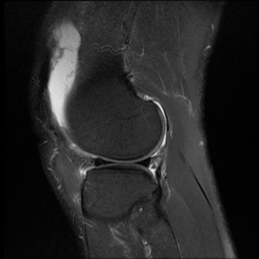 File:Bucket handle tear - medial meniscus (Radiopaedia 69245-79026 Sagittal PD fat sat 4).jpg