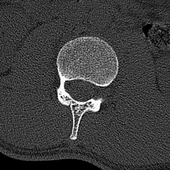 Burst fracture (Radiopaedia 53373-59357 Axial bone window 25).jpg