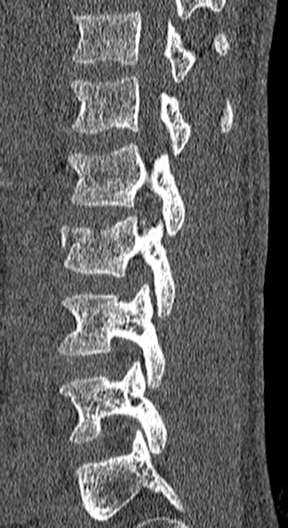 Burst fracture (Radiopaedia 53373-59357 Sagittal bone window 21).jpg