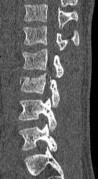 Burst fracture (Radiopaedia 53373-59357 Sagittal bone window 23).jpg