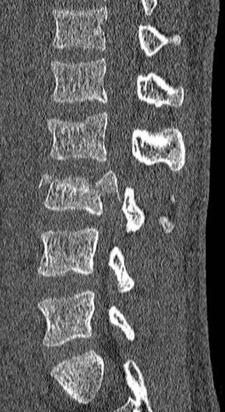 File:Burst fracture (Radiopaedia 53373-59357 Sagittal bone window 28).jpg