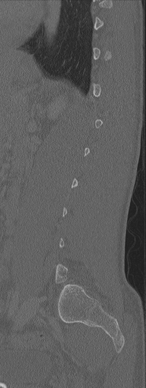 Burst fracture - T12 with conus compression (Radiopaedia 56825-63647 Sagittal bone window 22).png