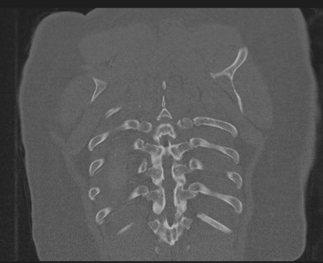 File:Burst fracture - thoracic spine (Radiopaedia 30238-30865 Coronal bone window 142).jpg
