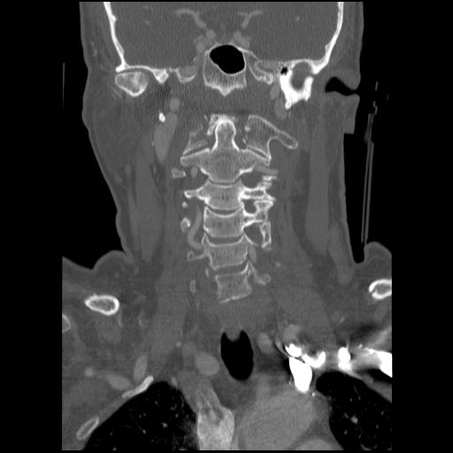 C1 anterior arch (plough) fracture - type 1 (Radiopaedia 76181-87720 Coronal bone window 57).jpg