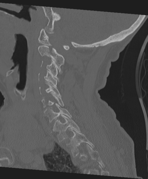 C2 fracture with vertebral artery dissection (Radiopaedia 37378-39199 Sagittal bone window 49).png