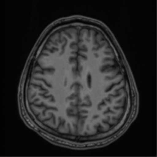 CNS vasculitis (Radiopaedia 55715-62263 Axial T1 63).png
