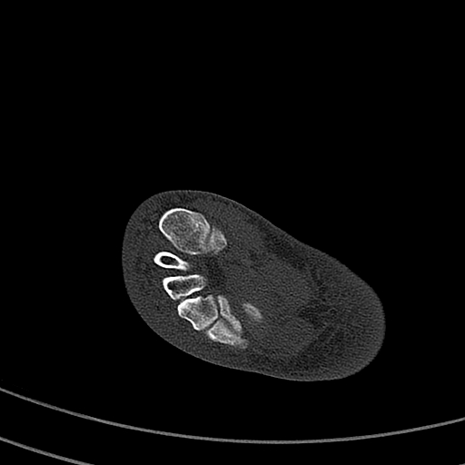 File:Calcaneal fracture - Sanders type 4 (Radiopaedia 90179-107370 Axial bone window 46).jpg