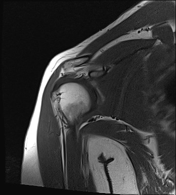 File:Calcific tendinitis of the infraspinatus tendon (Radiopaedia 87256-103537 Coronal T1 9).jpg