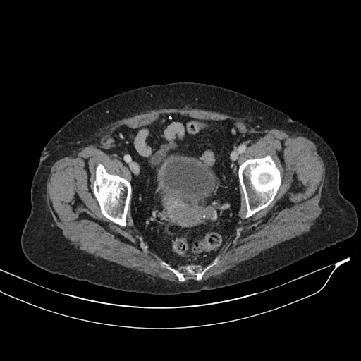 Calcified adrenal glands and Spigelian hernia (Radiopaedia 49741-54988 A 215).jpg