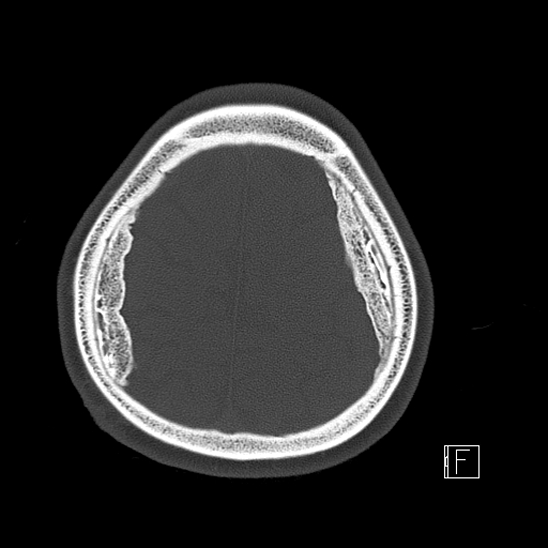 Calcified chronic subdural hematoma (Radiopaedia 77374-89492 Axial bone window 113).jpg